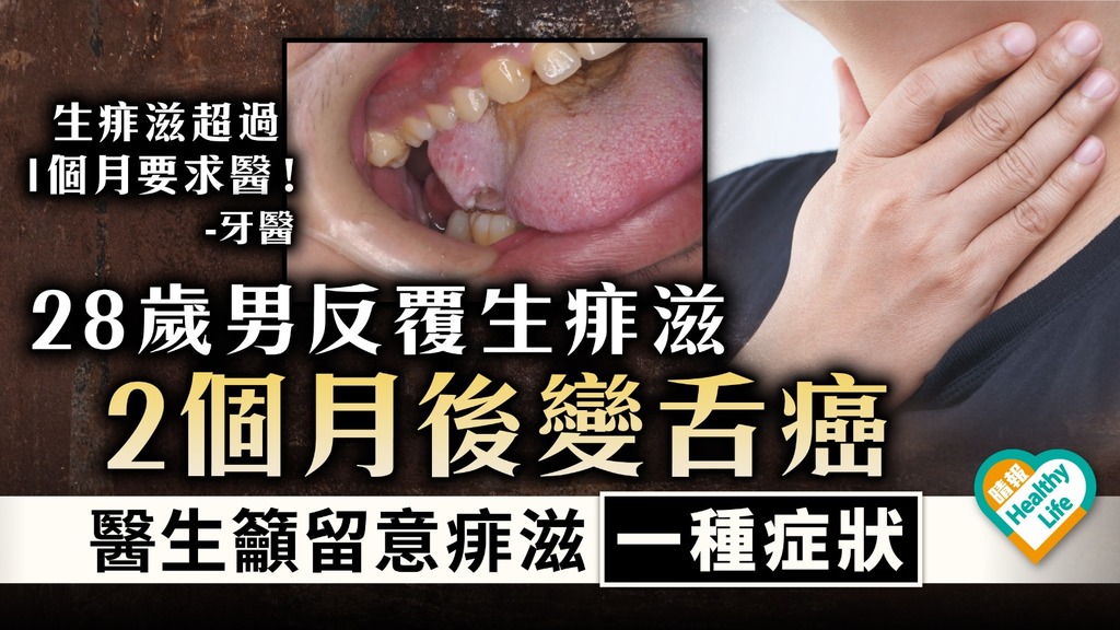 小病變大病｜28歲男反覆生痱滋2個月後變舌癌 醫生籲留意痱滋一種症狀