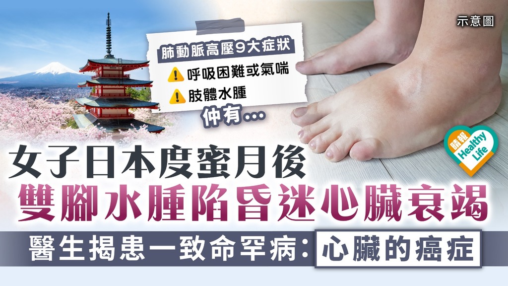 肺動脈高壓｜女子日本度蜜月後 雙腳水腫陷昏迷心臟衰竭 醫生揭患一致命罕病：心臟的癌症