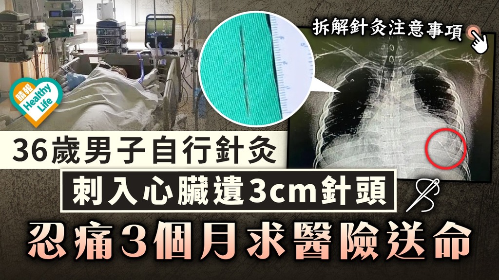 自行針灸│36歲男子自行針灸 刺入心臟遺3cm針頭 忍痛3個月求醫險送命