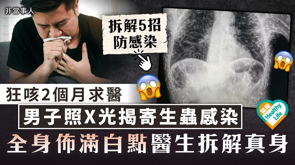 觸目驚心｜狂咳2個月求醫 男子照X光揭寄生蟲感染 全身佈滿白點醫生拆解真身