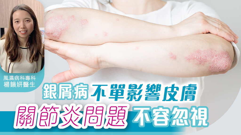 銀屑病不單影響皮膚 關節炎問題不容忽視