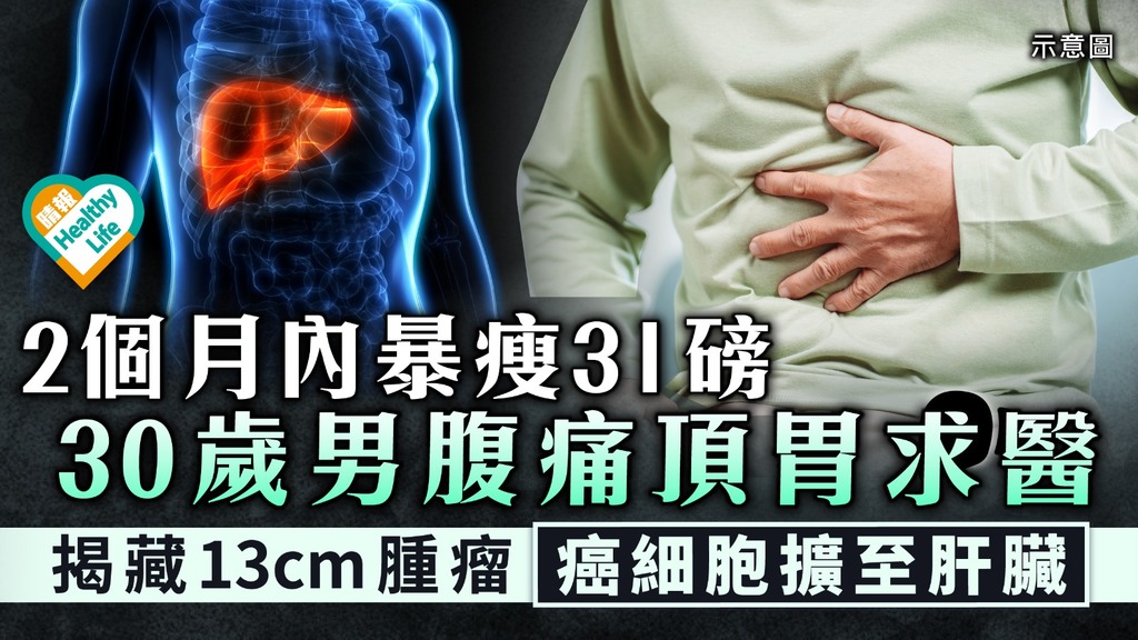 癌症殺手｜2個月內暴瘦31磅 30歲男腹痛頂胃求醫 揭藏13cm腫瘤癌細胞擴至肝臟