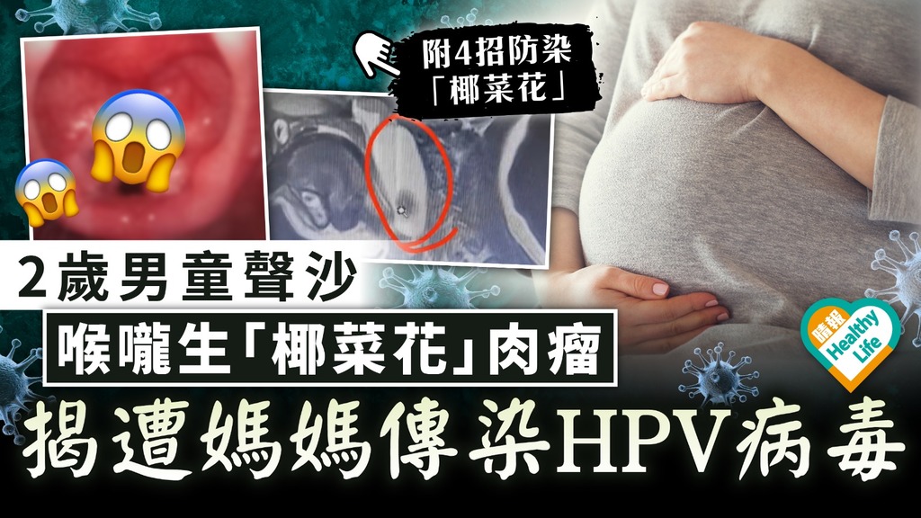 性病傳染｜2歲男童聲沙 喉嚨生「椰菜花」肉瘤 求醫揭遭媽媽傳染HPV病毒