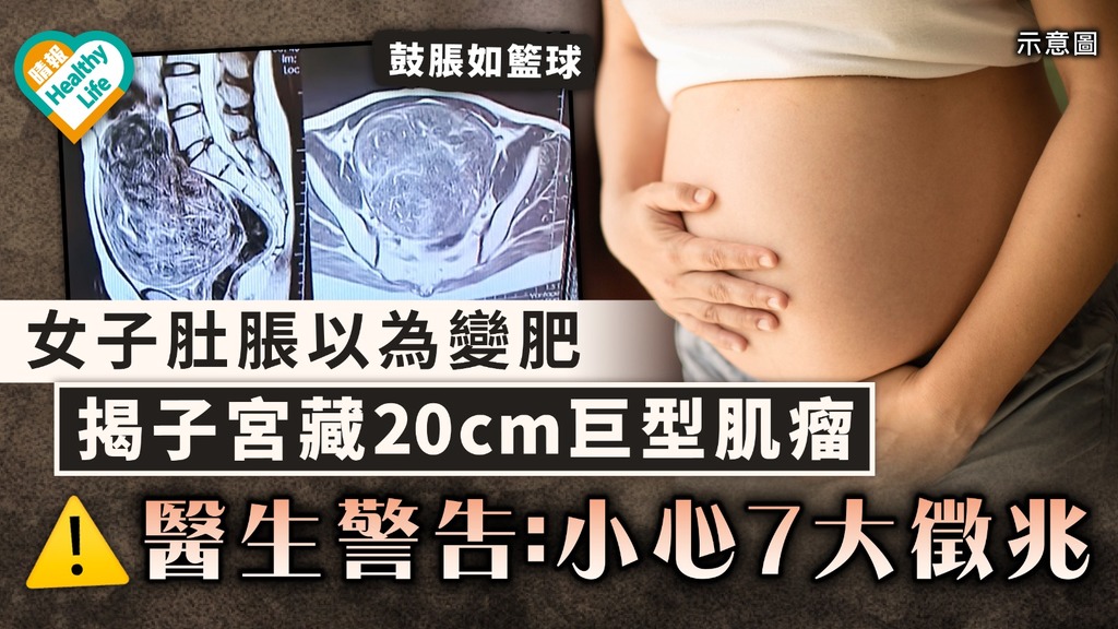 女士注意｜女子肚脹以為變肥 揭子宮藏20cm巨型肌瘤 醫生警告：小心7大徵兆