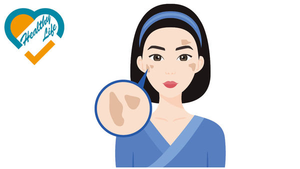 都市女性易患黃褐斑 中藥外敷內服＋針灸 助去斑
