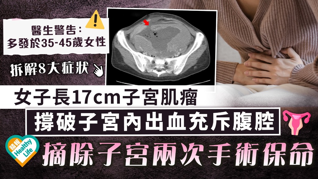 女士注意｜女子長17cm子宮肌瘤 撐破子宮內出血充斥腹腔 摘除子宮兩次手術保命
