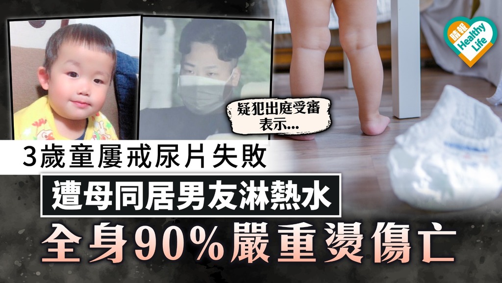 禽獸虐兒｜日3歲童屢戒尿片失敗 遭母同居男友淋熱水 全身90%嚴重燙傷亡