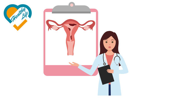 晚期子宮內膜癌 新療法助延存活