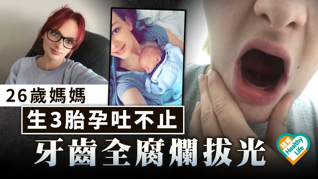 孕吐原因｜26歲媽媽生3胎孕吐不止 牙齒全腐爛拔光【附成因及解決方法】