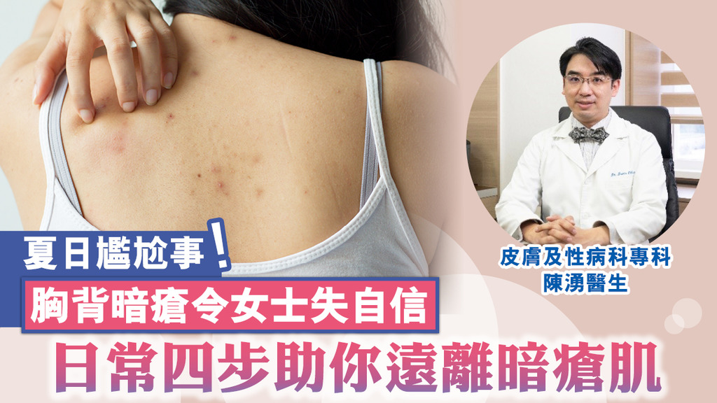 夏日尷尬事！胸背暗瘡令女士失自信 日常四步助你遠離暗瘡肌