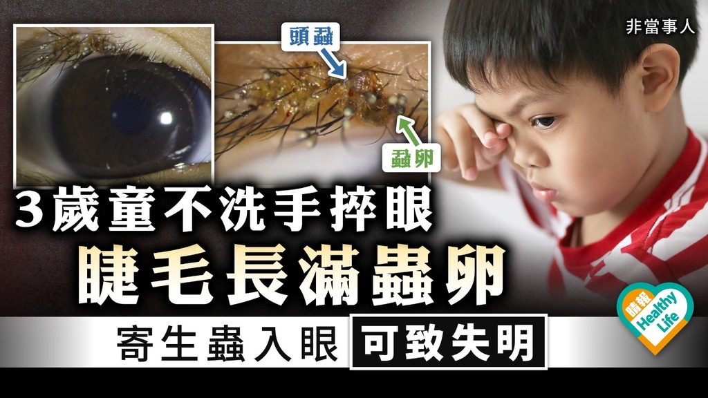 捽眼惹禍｜3歲童不洗手捽眼睫毛長滿蟲卵 專家：寄生蟲入眼可致失明