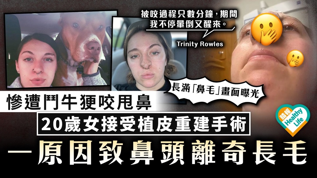 怪異「鼻毛」｜慘遭鬥牛㹴咬甩鼻 20歲女接受植皮重建手術 一原因致鼻頭離奇長毛 