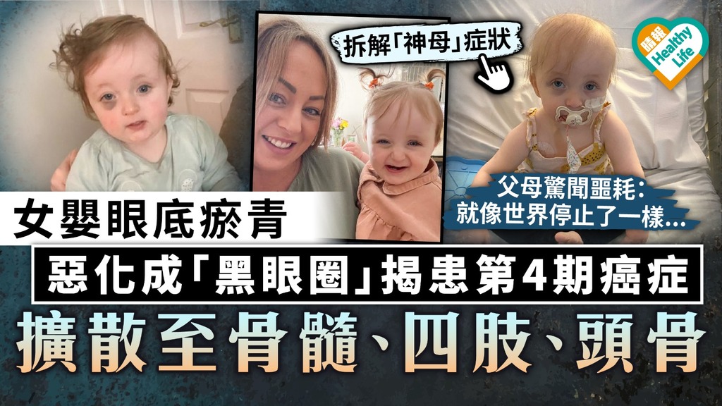 兒童腫瘤｜女嬰眼底瘀青 惡化成「黑眼圈」揭患第4期癌症 擴散至骨髓、四肢、頭骨