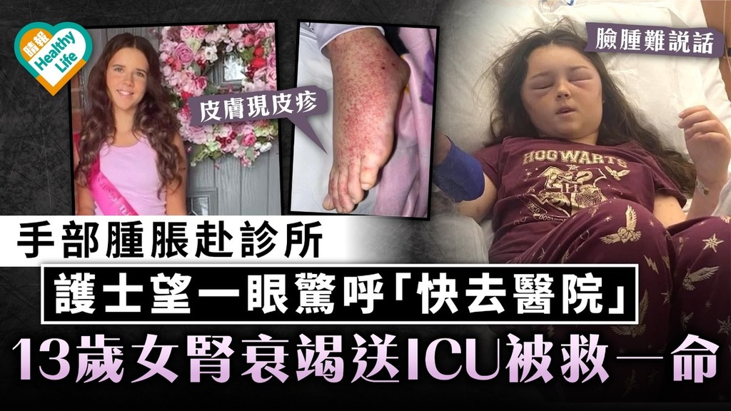 恐怖怪病｜手部腫脹赴診所 護士望一眼驚呼「快去醫院」 13歲女腎衰竭送ICU被救一命