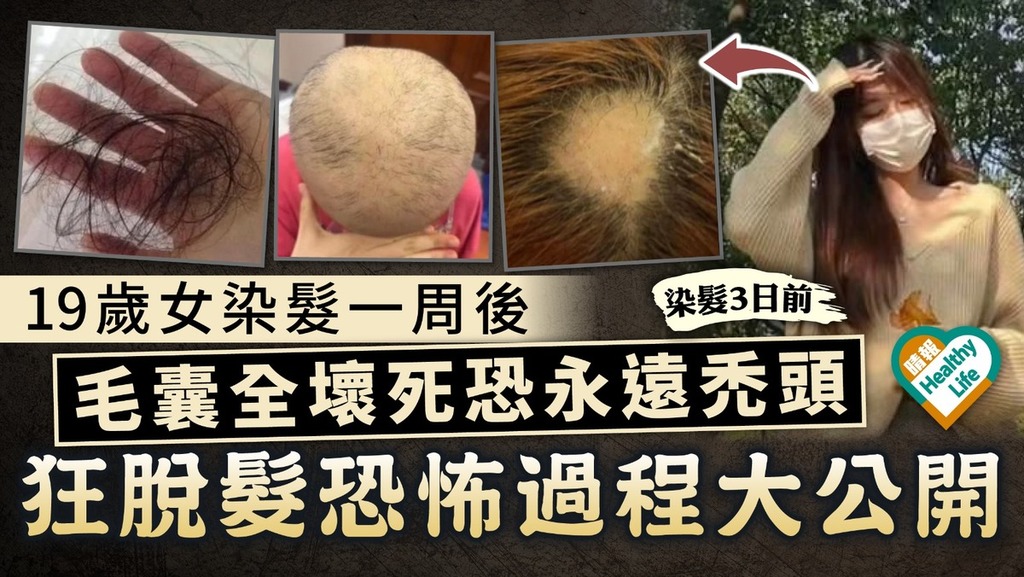 染髮風險｜19歲女染髮一周後 毛囊全壞死恐永遠禿頭 狂脫髮恐怖過程大公開