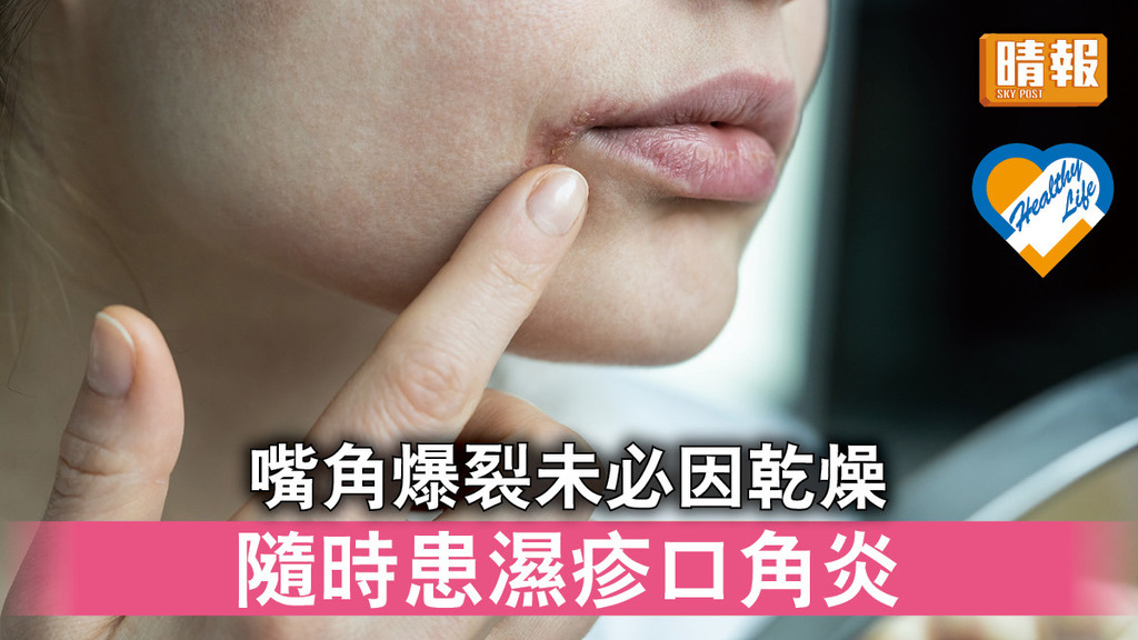 皮膚護理 │ 嘴角爆裂未必因乾燥 隨時患濕疹口角炎