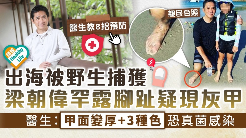 指甲健康｜出海被野生捕獲 梁朝偉罕露腳趾疑現灰甲 醫生：甲面變厚+3種色恐真菌感染