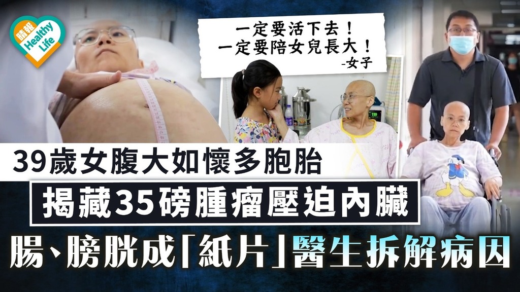 惡病纏身｜39歲女腹大如懷多胞胎 揭藏35磅腫瘤壓迫內臟 腸、膀胱成「紙片」醫生拆解病因