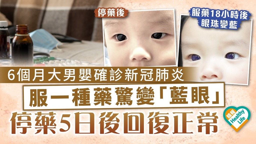 新冠藥物︳6個月大男嬰確診新冠肺炎 服一種藥驚變「藍眼」 停藥5日後回復正常