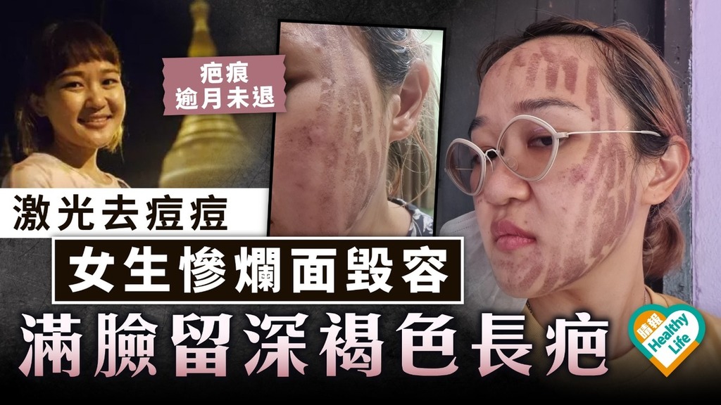 美容變毀容｜泰女生激光去痘痘慘爛面毀容 滿臉留深褐色長疤