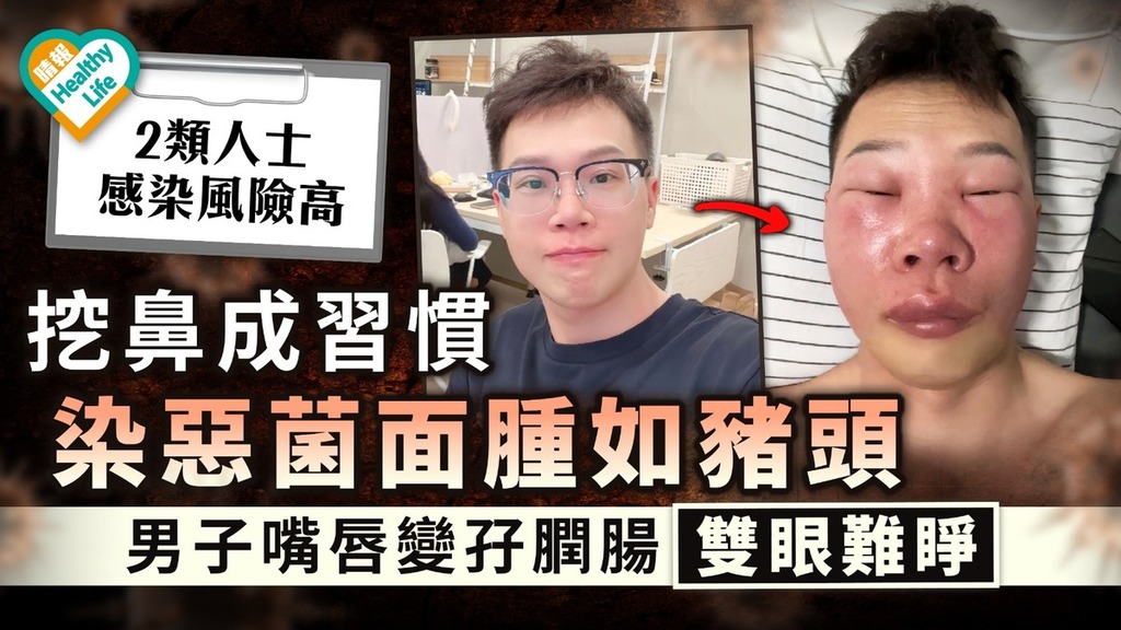 細菌感染｜愛挖鼻染惡菌面腫如豬頭 男子嘴唇變孖膶腸雙眼難睜