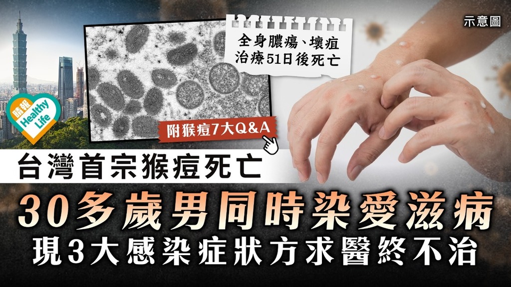 猴痘病毒｜台灣首宗猴痘死亡 30多歲男同時染愛滋病 現3大感染症狀方求醫終不治