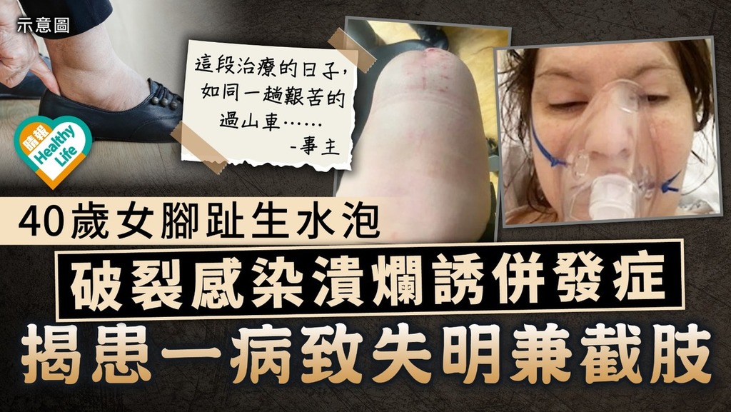 長期病患｜40歲女腳趾生水泡 破裂感染潰爛誘併發症 揭患一病致失明兼截肢
