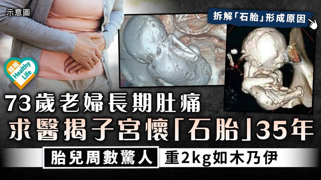 胎死腹中｜73歲老婦長期肚痛 求醫揭子宮懷「石胎」35年 胎兒周數驚人重2kg如木乃伊