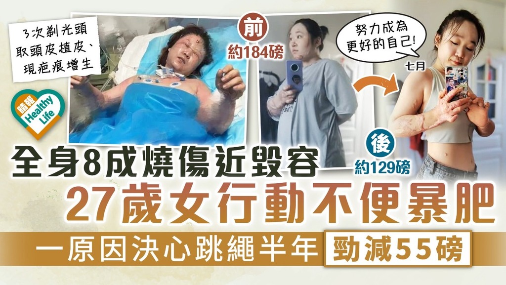 浴火重生｜全身8成燒傷近毀容 27歲女行動不便暴肥 一原因決心跳繩半年勁減55磅
