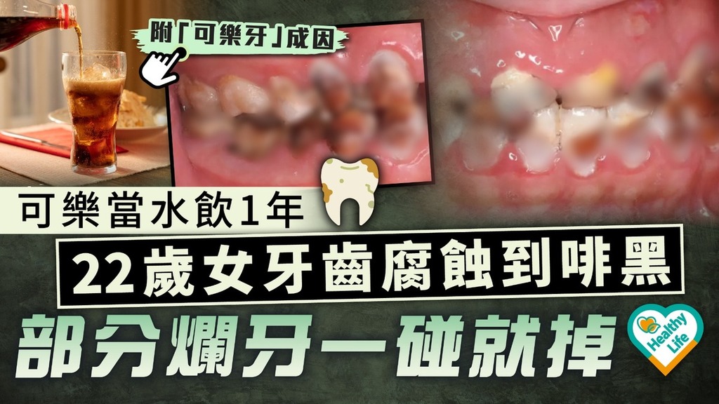 牙齒健康｜可樂當水飲1年 22歲女牙齒腐蝕到啡黑 部分爛牙一碰就掉