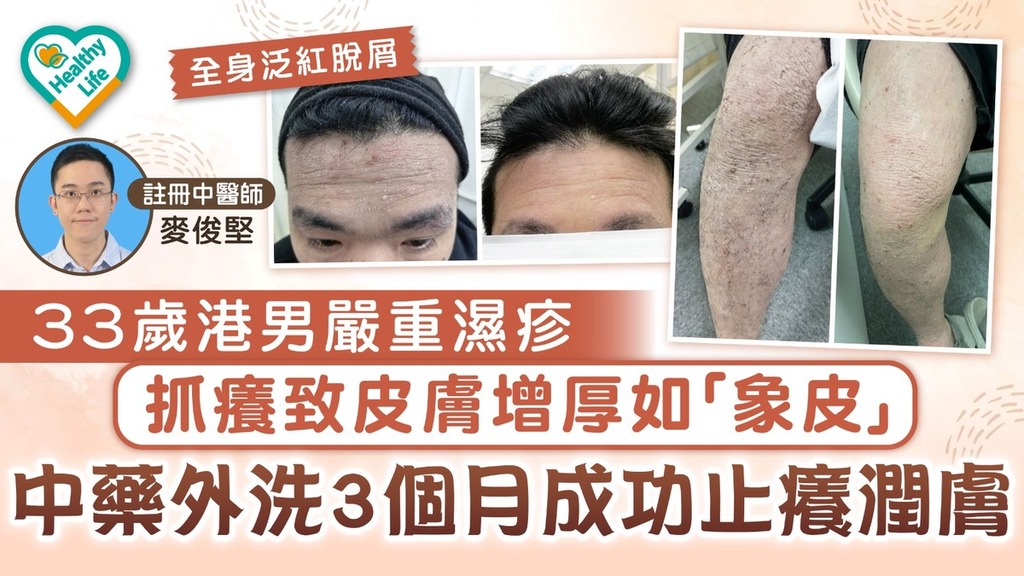 KO濕疹︱33歲港男嚴重濕疹抓癢致皮膚增厚如「象皮」 中藥外洗3個月成功止癢潤膚