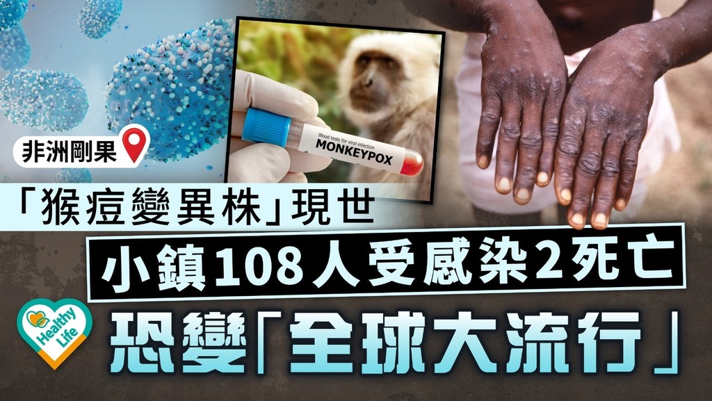 猴痘病毒丨「猴痘變異株」現世108人受感染2死亡 恐變「全球大流行」