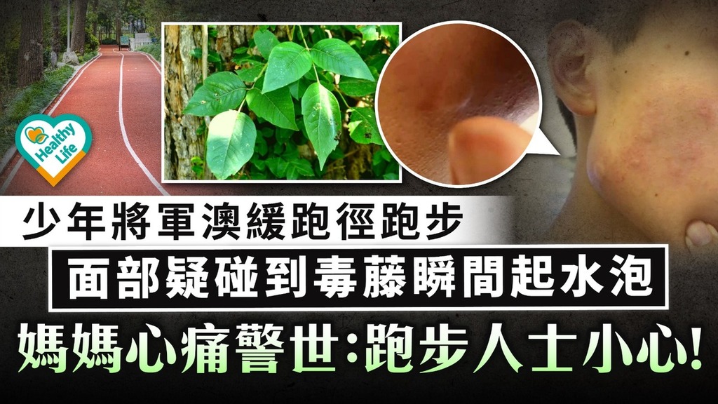 有毒植物︱少年將軍澳跑步面部疑碰到毒藤瞬間起水泡 媽媽心痛警世：跑步人士小心！