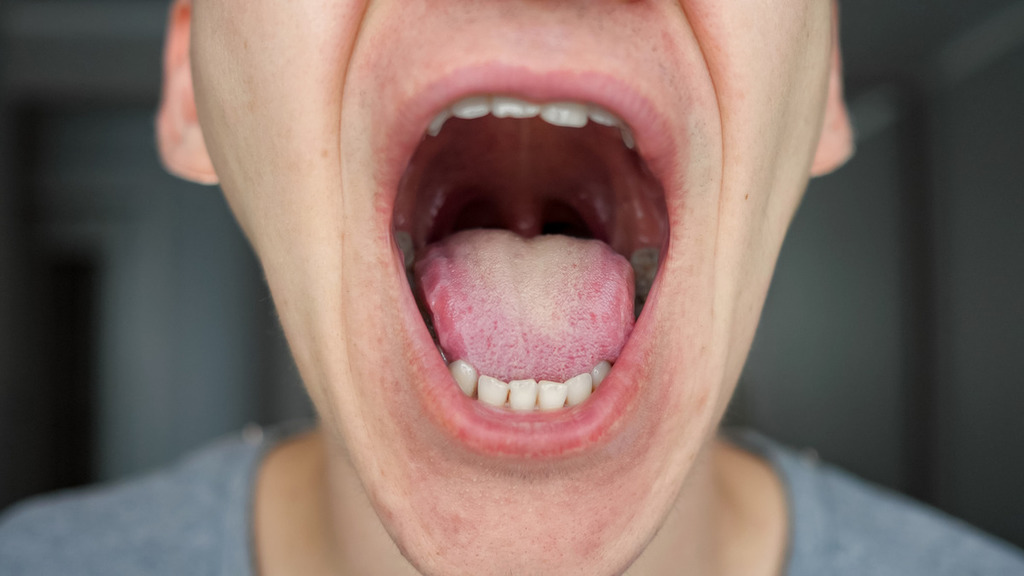 口腔健康｜港男身體疲倦有氣無力 起床發現舌頭全白舌底長血泡 中醫教2類食物要戒口