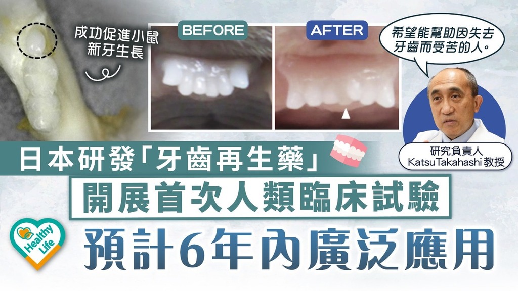 牙齒再生｜日本研發「牙齒再生藥」開展首次人類臨床試驗 預計6年內廣泛應用