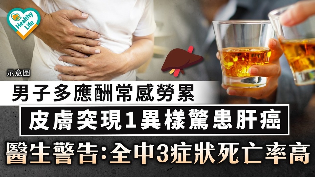 肝硬化｜男子常感勞累皮膚突現1異樣驚患肝癌 醫生警告：全中3症狀死亡率高 【附ABCDE自我檢測】