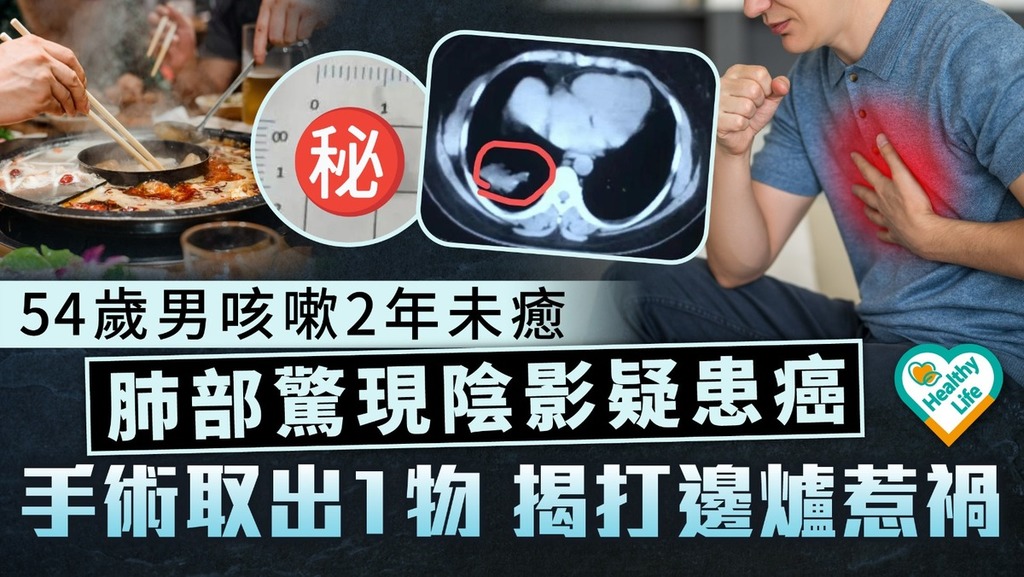 食用安全︱54歲男咳嗽2年未癒肺部驚現陰影疑患癌 手術取出1物揭打邊爐惹禍