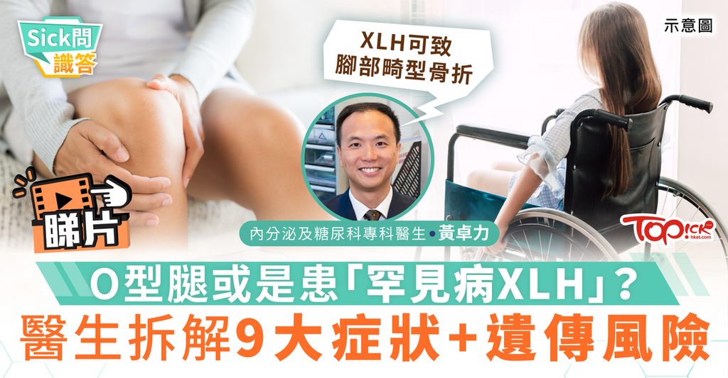 Sick問識答｜O型腿或是患「罕見病XLH」？醫生拆解9大症狀+遺傳風險