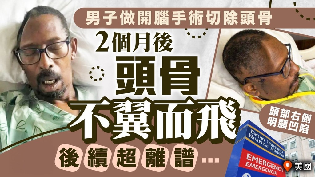 醫療事故丨男子腦出血緊急做開腦手術 2個月後頭骨竟不翼而飛後續超離譜