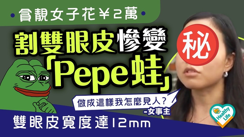 整容惹禍丨貪靚女子花¥2萬割雙眼皮慘變「Pepe蛙」 雙眼皮寬度達12mm