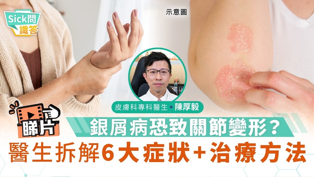 Sick問識答｜銀屑病恐致關節變形？醫生拆解6大症狀+治療方法