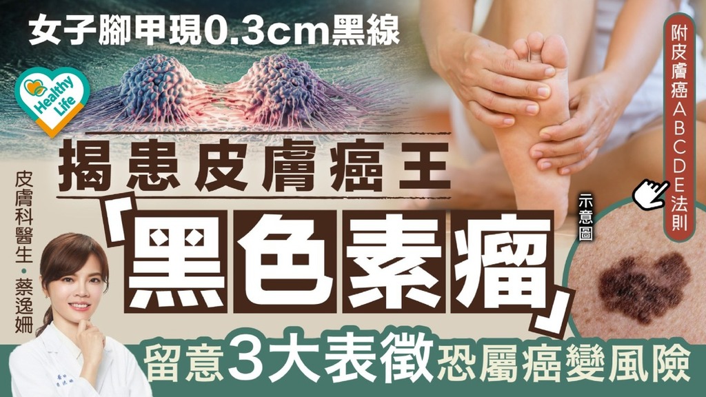 黑色素瘤｜女子腳甲現0.3cm黑線 揭患皮膚癌王「黑色素瘤」 留意3大表徵恐屬癌變風險【附皮膚癌ABCDE法則】