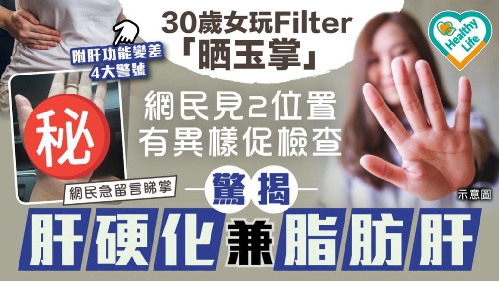 肝病警號｜30歲女玩Filter「晒玉掌」 網民見2位置有異樣促檢查 驚揭肝硬化兼脂肪肝【附肝功能變差4大警號】