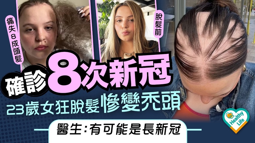 脫髮危機｜確診8次新冠 23歲女狂脫髮慘變禿頭 醫生：有可能是長新冠