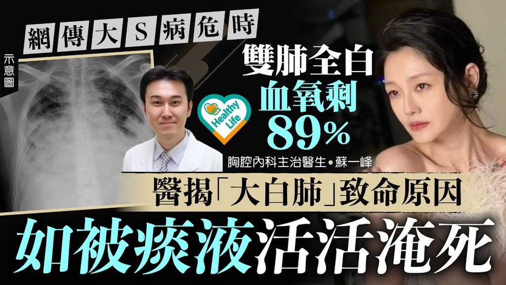 大S離世丨大S病危時傳雙肺全白血氧剩89％ 醫生揭「大白肺」致命原因
