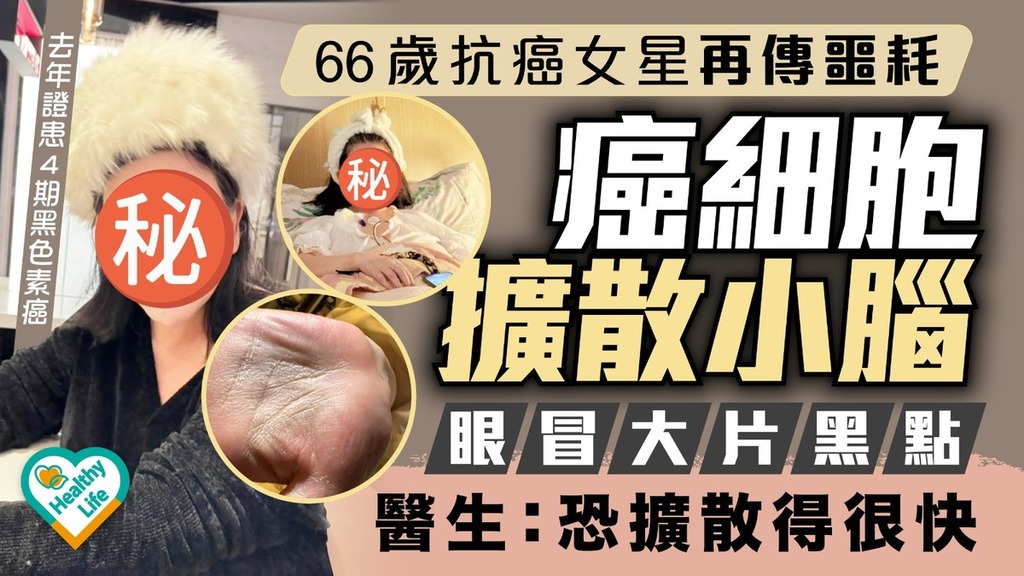 抗癌勇士｜66歲抗癌女星再傳噩耗癌細胞擴散小腦 眼冒大片黑點醫生：恐擴散得很快