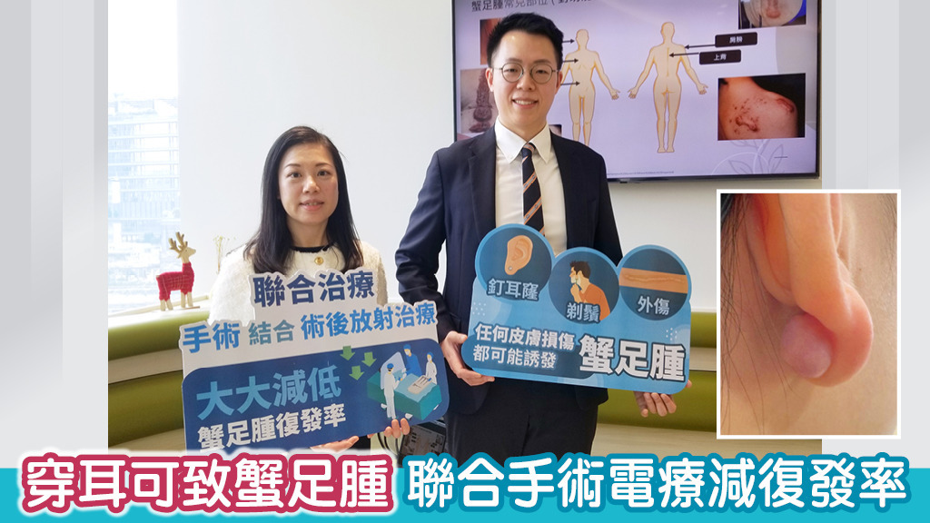 穿耳可致蟹足腫 聯合手術電療減復發率