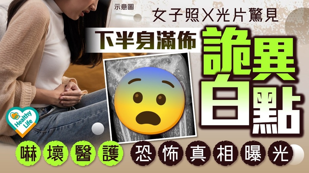 禍從口入｜疑食1類食物肇禍 婦人X光片驚現恐怖畫面 下半身滿佈1物嚇壞醫護