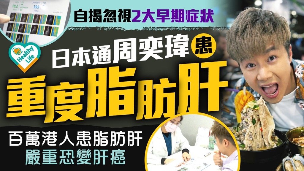 脂肪肝｜日本通周奕瑋自揭忽視2大早期症狀患重度脂肪肝 百萬港人患脂肪肝嚴重恐變肝癌