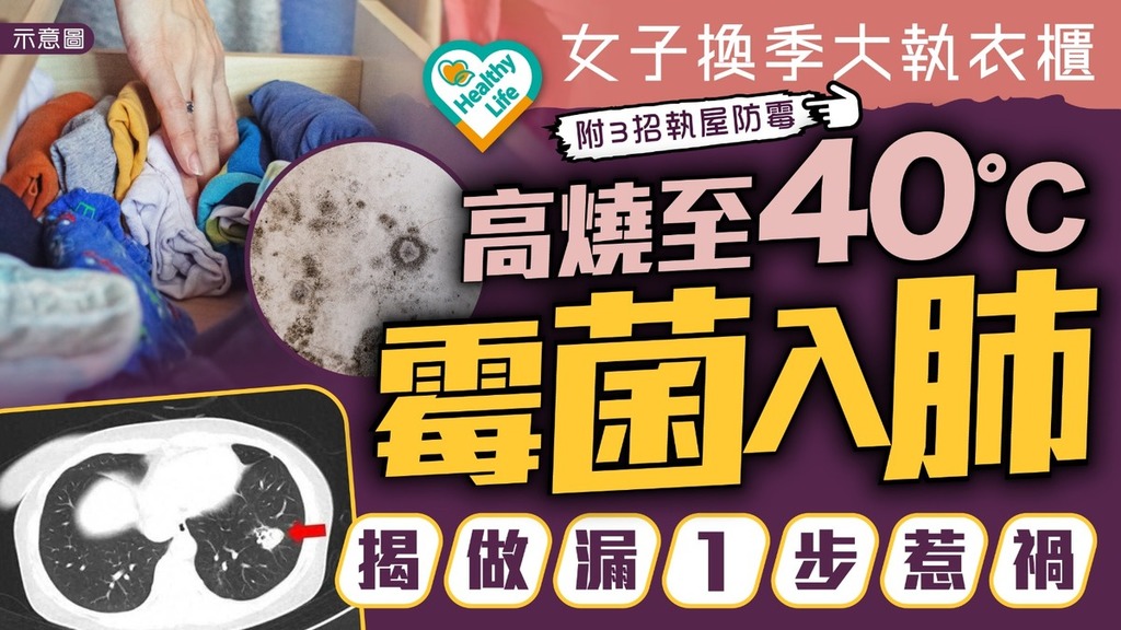 家居霉菌｜女子換季大執衣櫃後發高燒至40度 揭做漏1步致霉菌入肺【附3招執屋防霉】